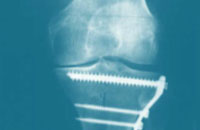 osteotomy-of-the-knee